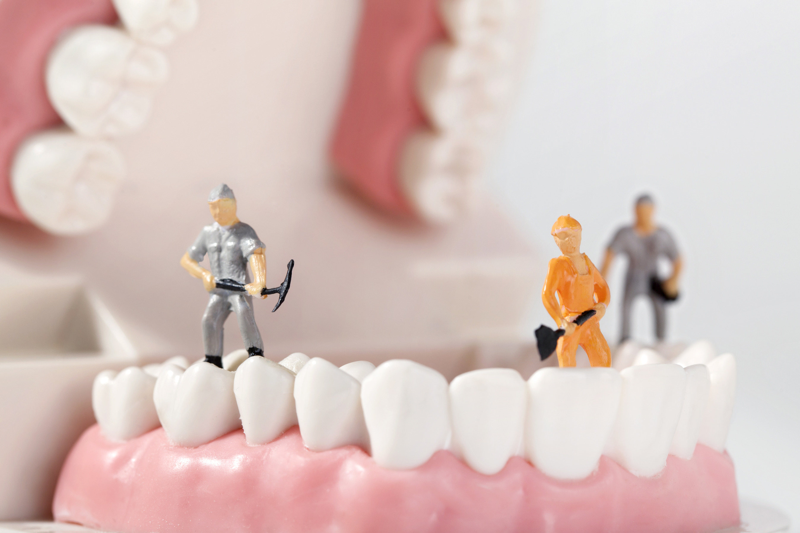 关于洗牙的误区是什么